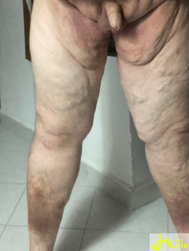bites de Vix44