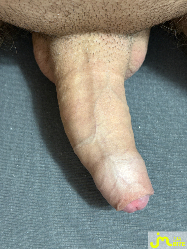 bites de Elantho