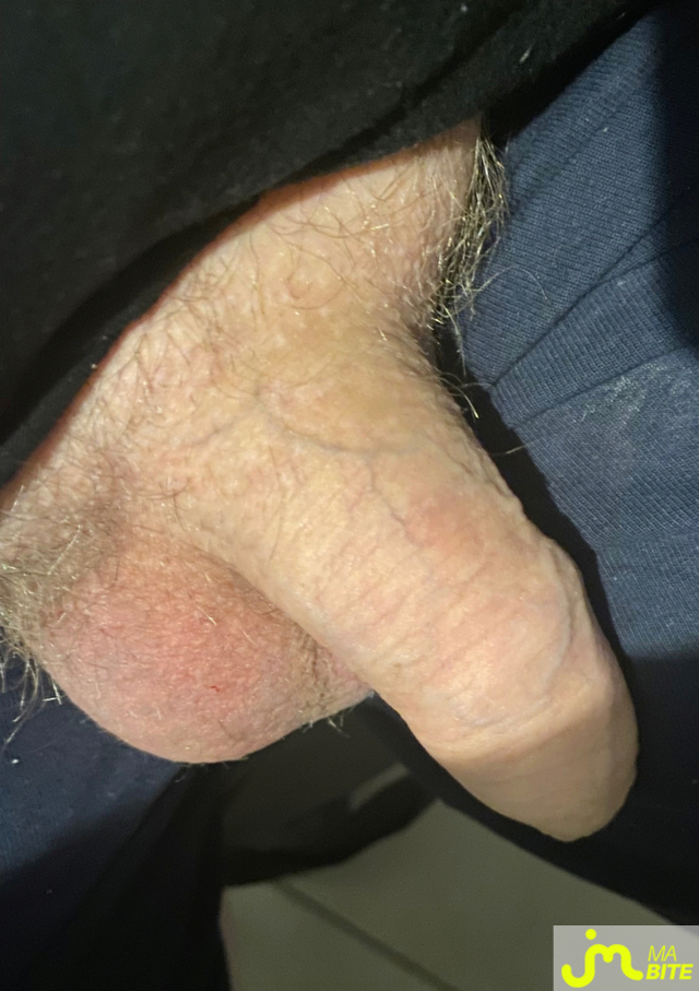 bites de lakeu