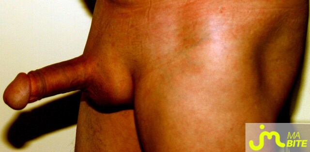 bites de zyrus