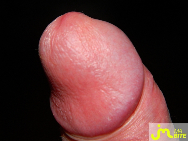 bites de jeunebite