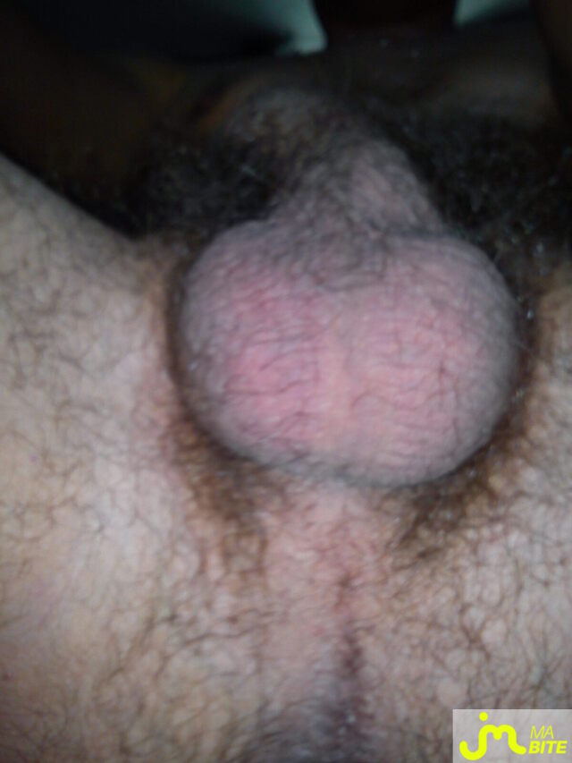 bites de jacks