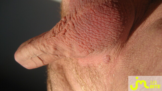 bites de latige