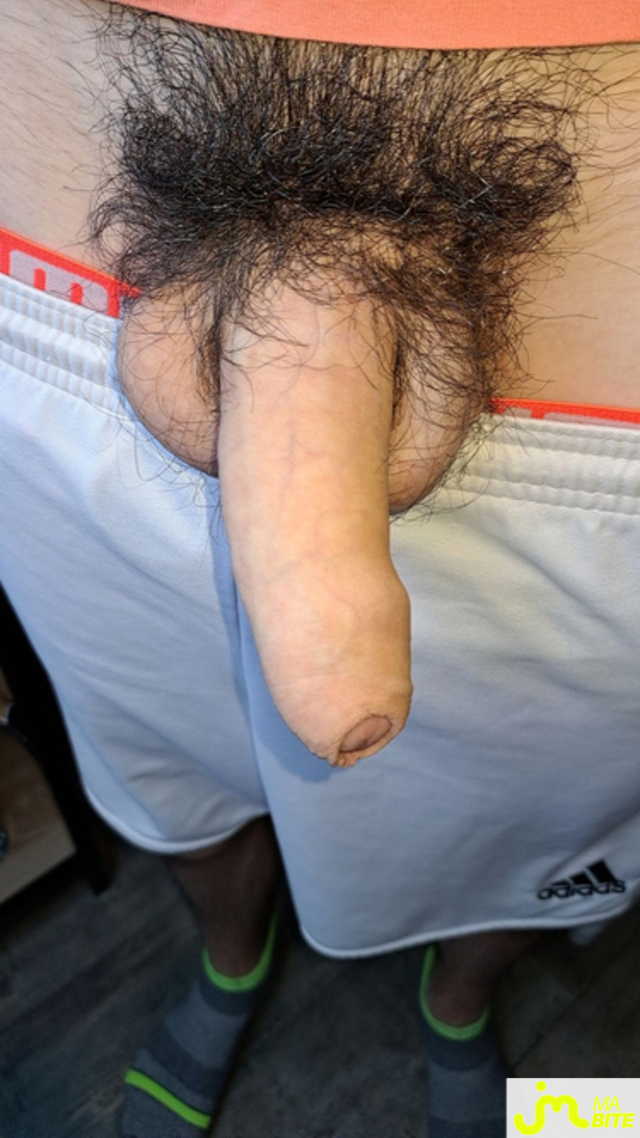 bites de Akonime