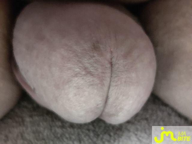 bites de suckingdicks81
