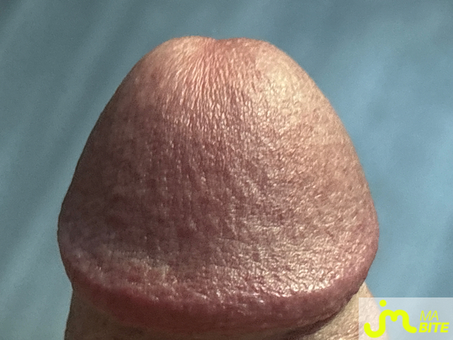 bites de Ziodinamite