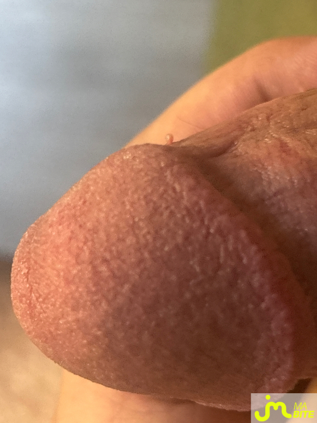 bites de Ziodinamite