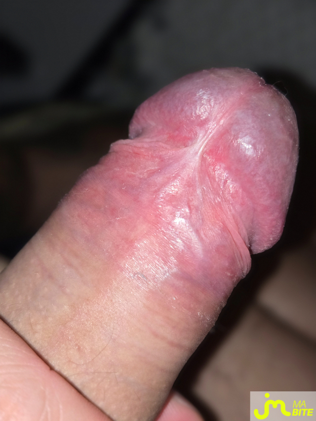 bites de Mbite