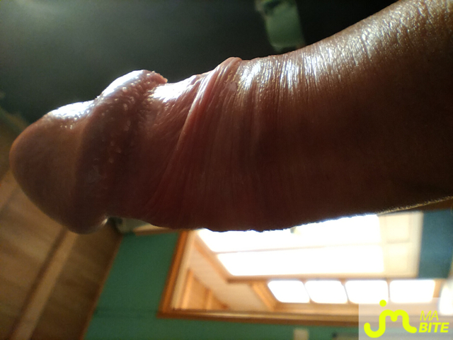 bites de hypo35