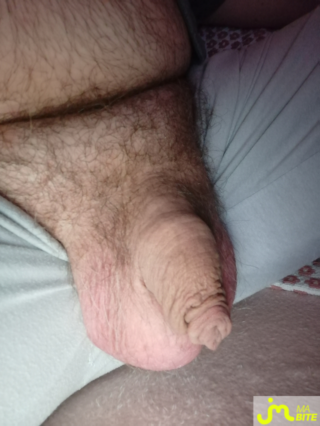 bites de Gangrène Plastique