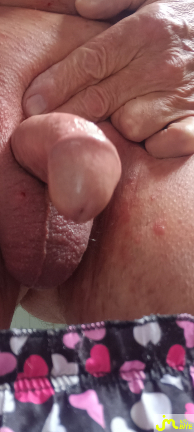 bites de Plastic 3157