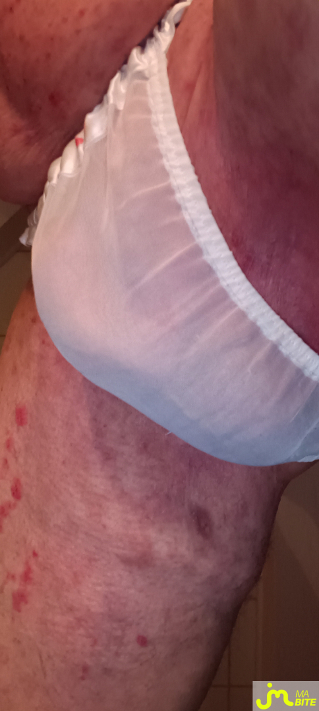 bites de Plastic 3157