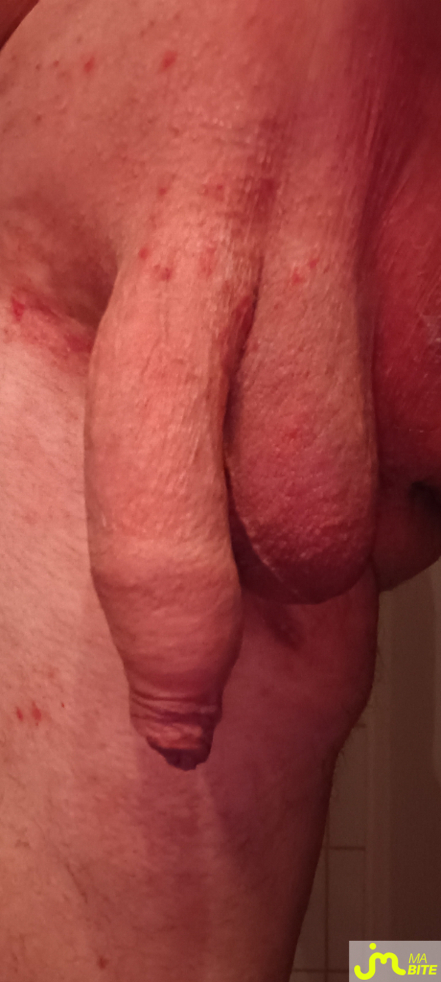 bites de Plastic 3157