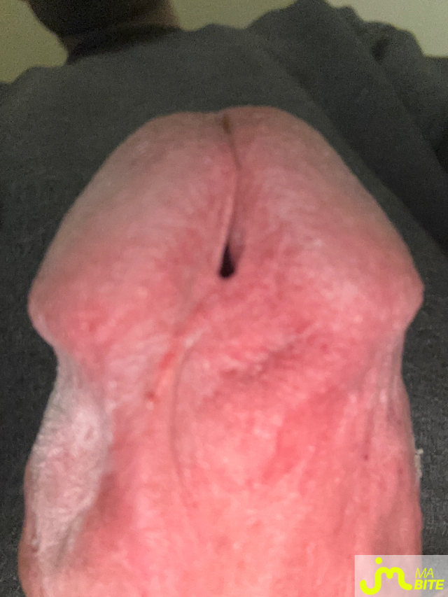 bites de Ziodinamite