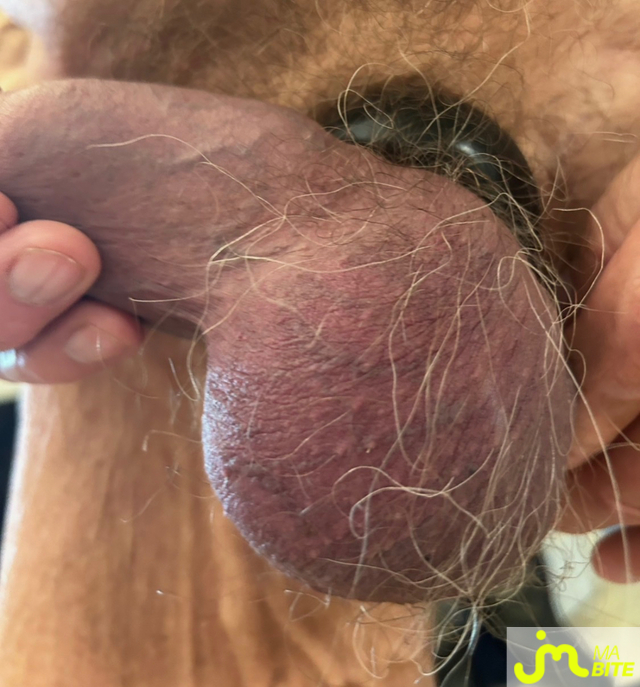 bites de Athl&egrave;te75