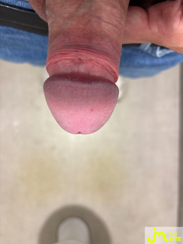 bites de Mangerl