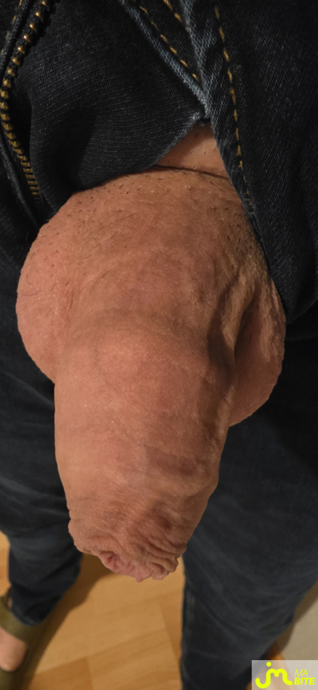 bites de bite_&ocirc;_veines