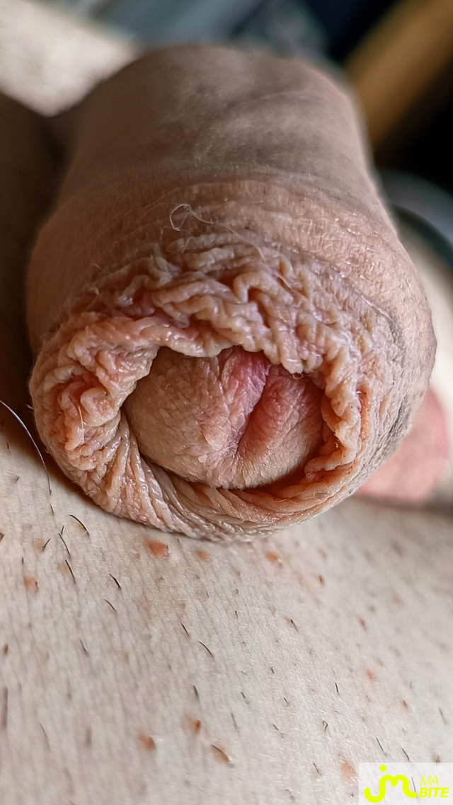bites de pr&eacute;puce 29