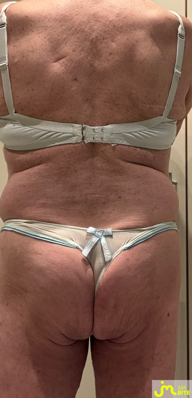 bites de Menelas