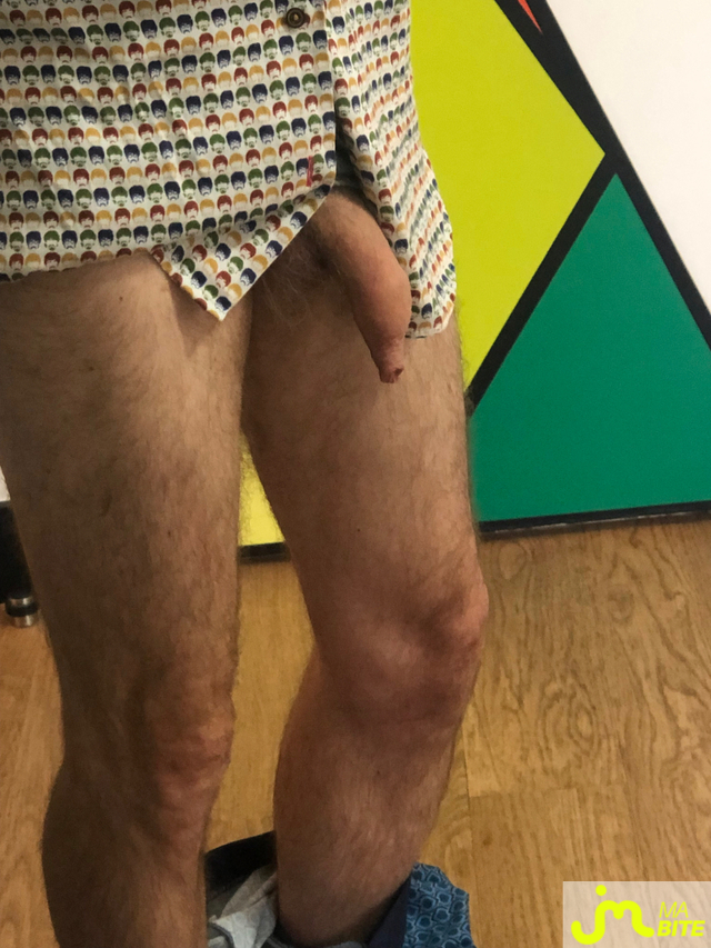 bites de longprepuce